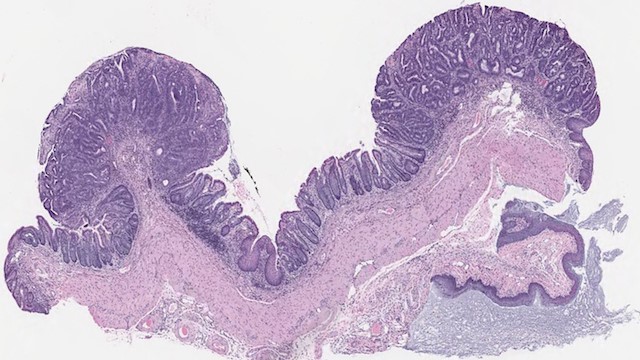 肠道类器官移植快速形成结直肠癌小鼠模型