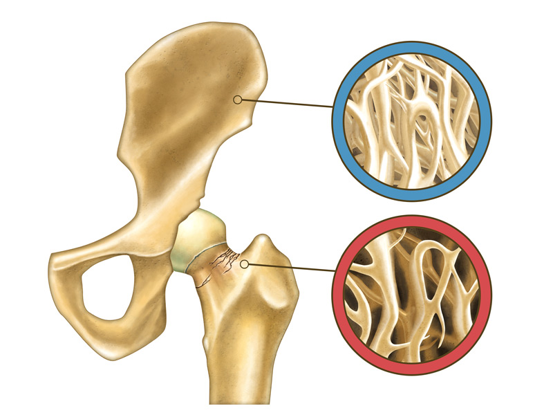 ELISA系列 （4）▏骨质疏松症相关热门因子介绍